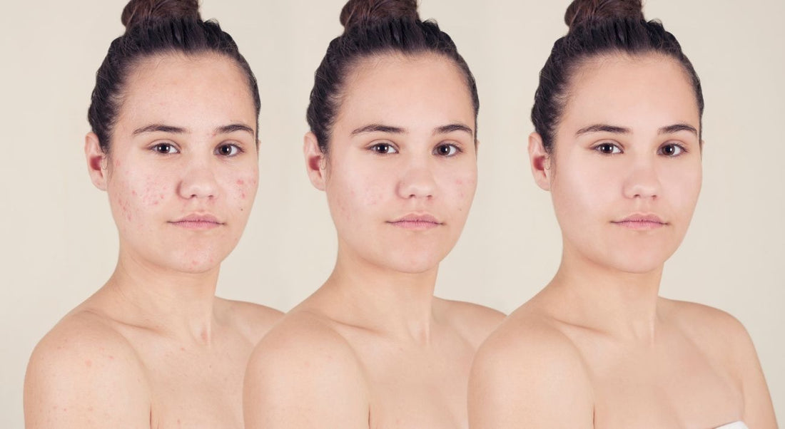 Top 5 K-Beauty Products for Acne-Prone Skin: Clear Skin Secrets