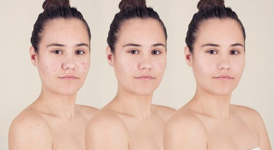 Top 5 K-Beauty Products for Acne-Prone Skin: Clear Skin Secrets